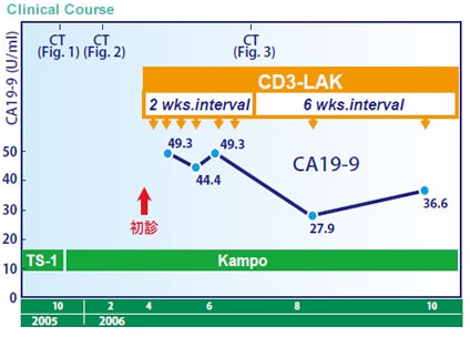 TS-1耐药后经免疫细胞疗法治疗后缓解的胃癌案例1