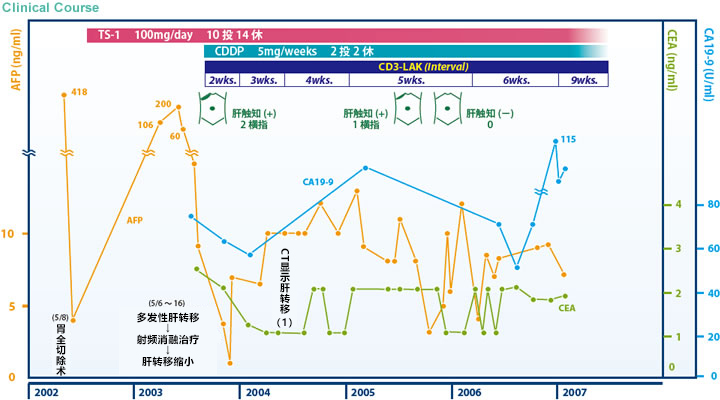 日本免疫细胞治疗案例-胃癌