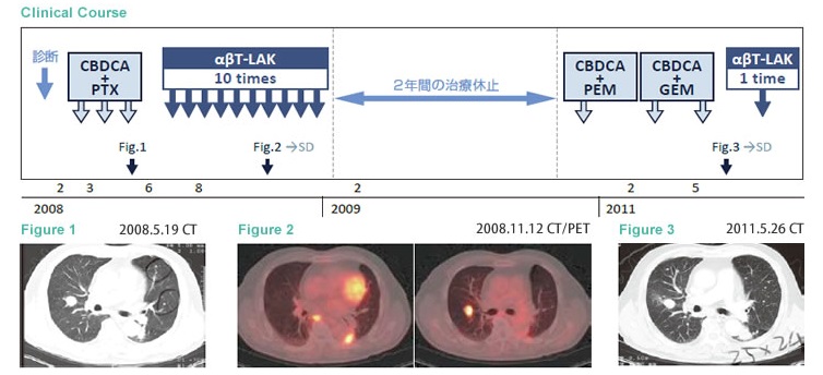 αβT细胞治疗维持三年稳定状态的肺腺癌案例1